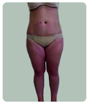 Благодаря капсулам Inteslim Formula отеки вес заметно уменьшился.